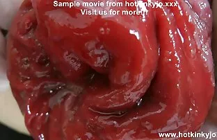 மற்றொரு முழங்கை ஆழமான குத ஃபிஸ்டிங் மற்றும் வயிற்று வீக்கம்