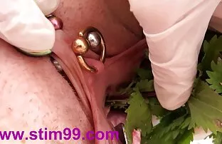 தேள் தேள் மற்றும் வால்வாவில் சிறுநீர்க்குழாய் அனஸ்டோமோசிஸ்
